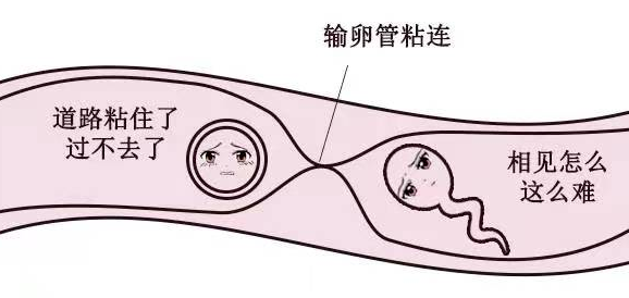 輸卵管粘連.png