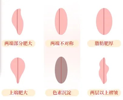 小陰唇.jpg